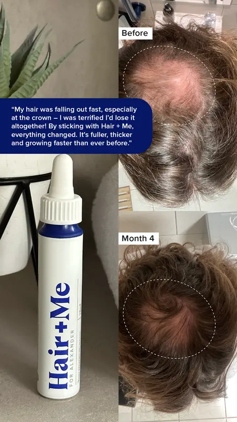 Hair + Me ad: Hair regrowth starts here