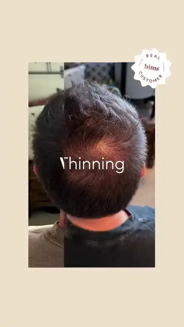 hims ad: Take control of hair loss today